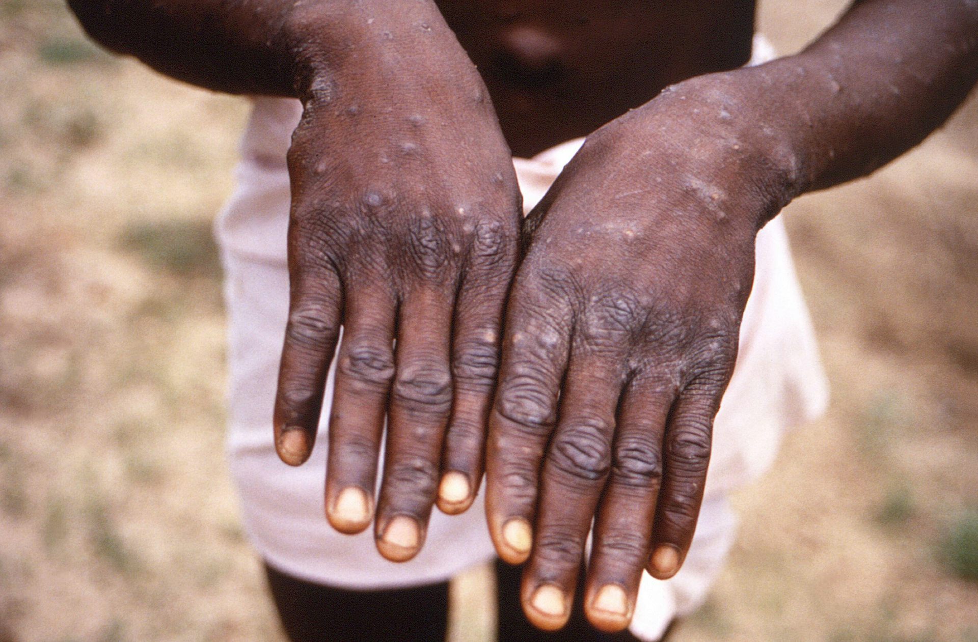 A person with mpox blisters on their hands.