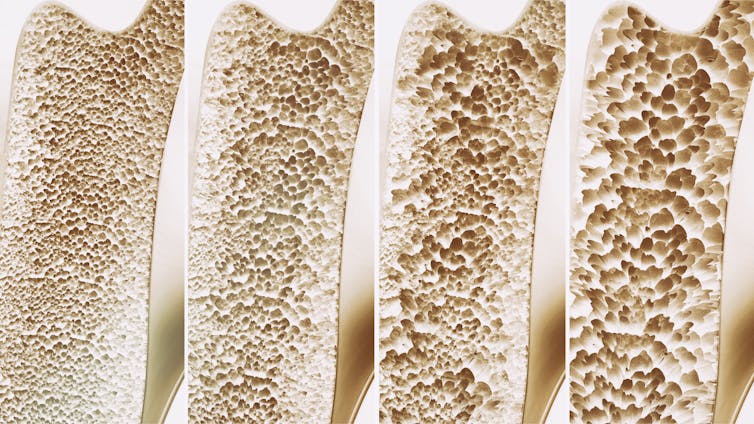 The interior of bones, showing four depictions of bone density – from healthy to severe osteoporosis.