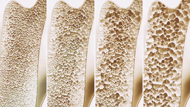The interior of bones, showing four depictions of bone density – from healthy to severe osteoporosis.