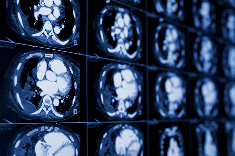 Grid of CT images of chest