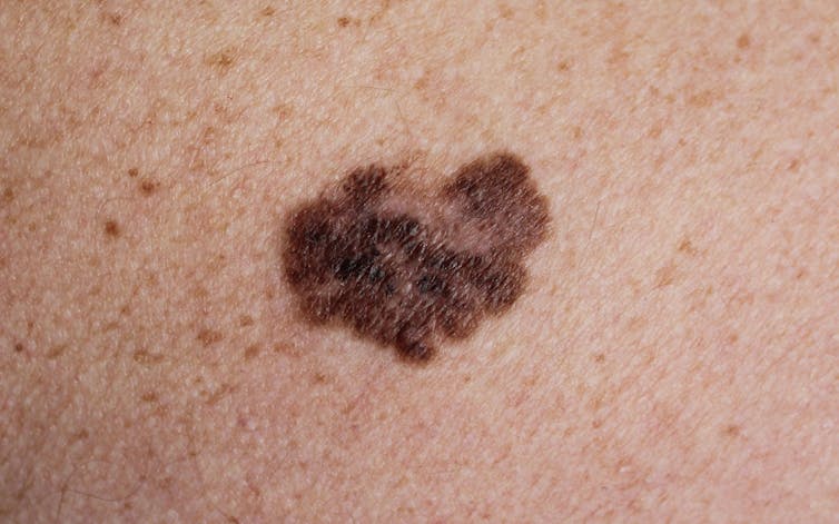 A picture of an irregular mole, which is a sign of melanoma.