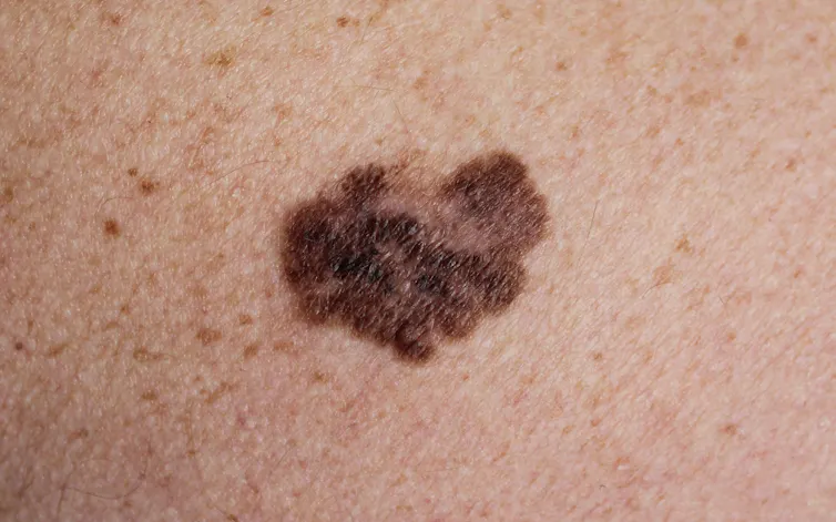 A picture of an irregular mole, which is a sign of melanoma.