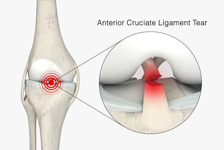 A diagram showing an ACL tear.