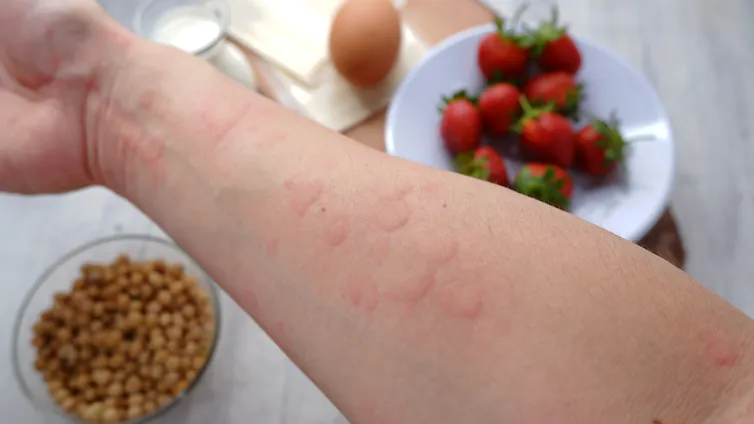 Hives