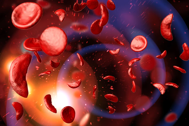 A digital drawing depicting the sickle shape red blood cells have in people with sickle cell disease.