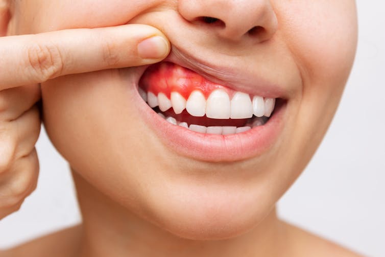 A person shows their red swollen gums, a sign of gum disease.