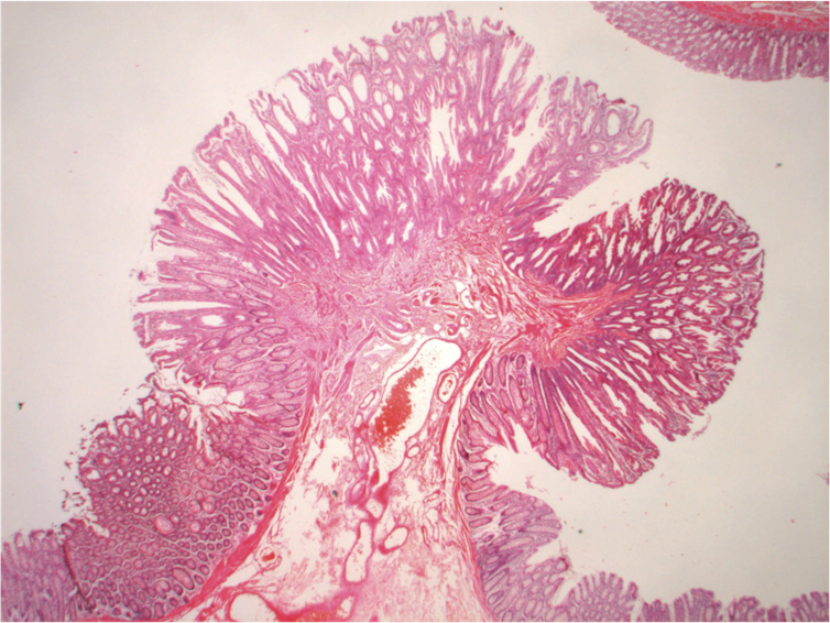Microscopic image of a colon polyp resembling a tree of pink spongy tissue with a rounded tip