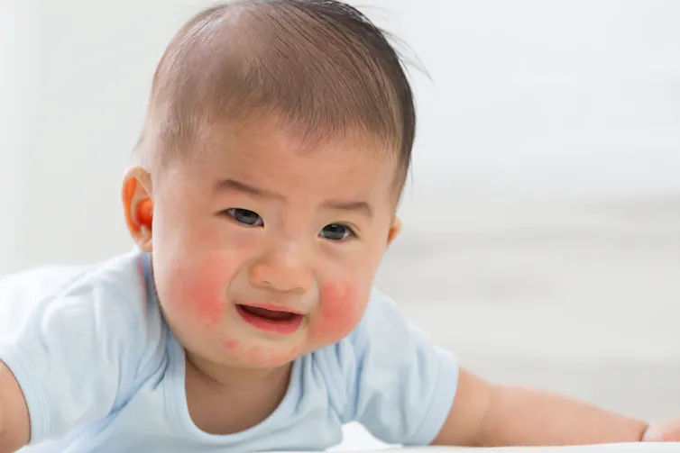 https://www.shutterstock.com/image-photo/skin-rashes-babies-concept-1228925236