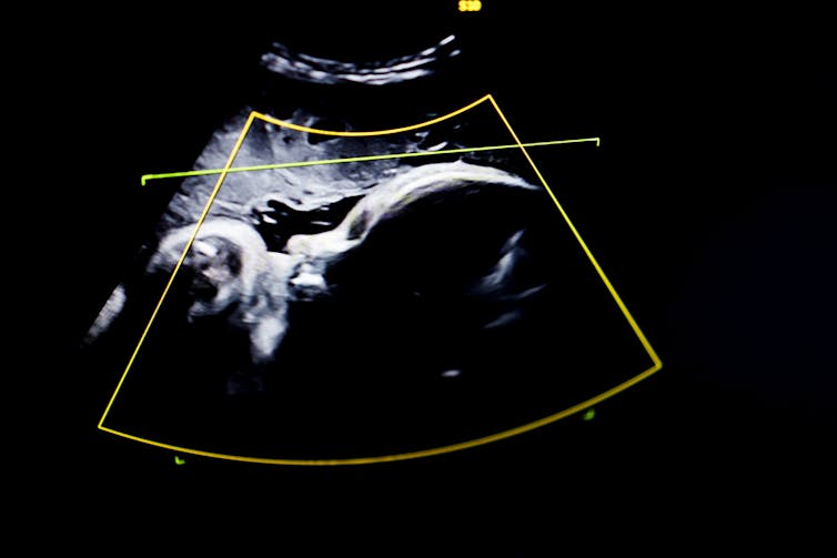 Ultrasound sonogram monitor of the developing fetus
