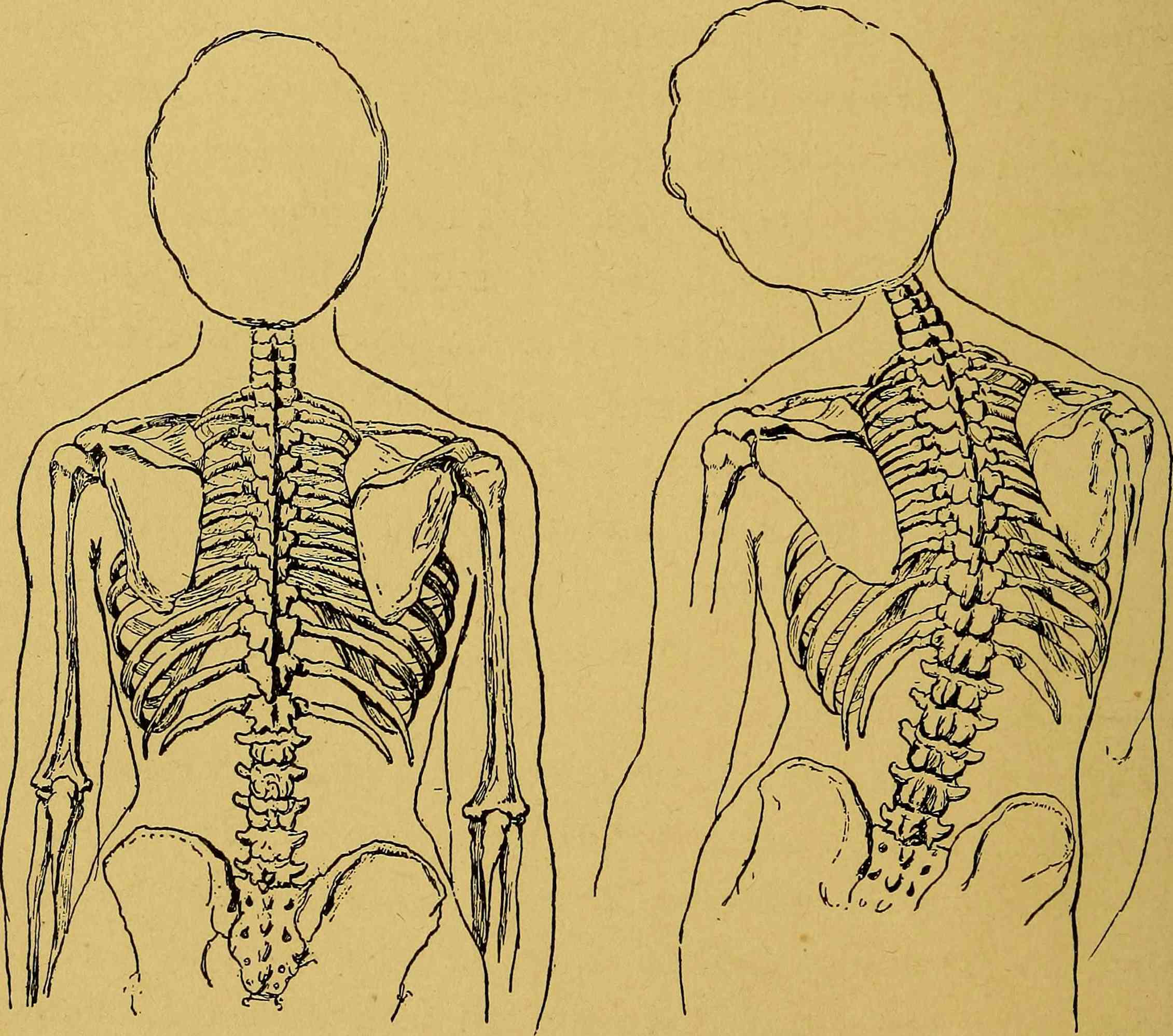 Explainer everything you need to know about scoliosis