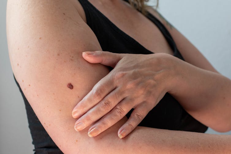 A woman's arm with a mole on it.