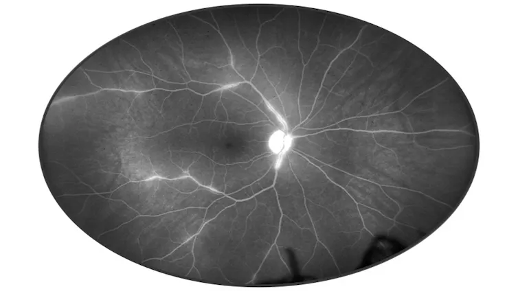 A black and white photo depicting a fluorescein angiography.