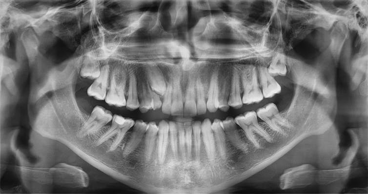 A greyscale image of a dental X-ray showing a full mouth of teeth.