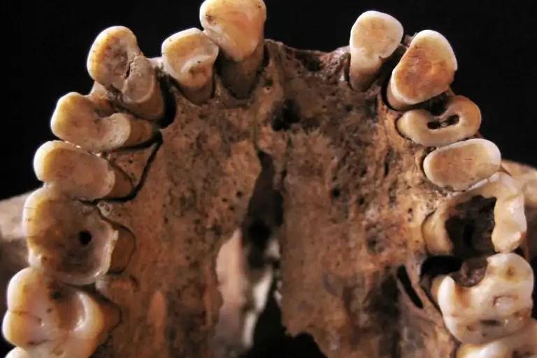 Tooth caries