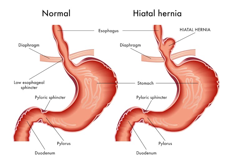 Graphic showing a hiatal hernia.