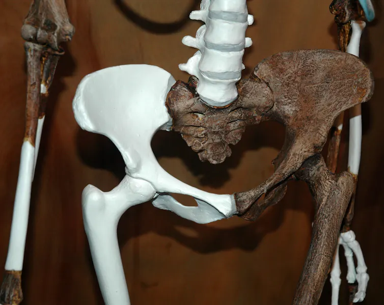 Uma coluna vertebral e uma pélvis humanas, com ossos fossilizados marrons e substitutos brancos modernos.