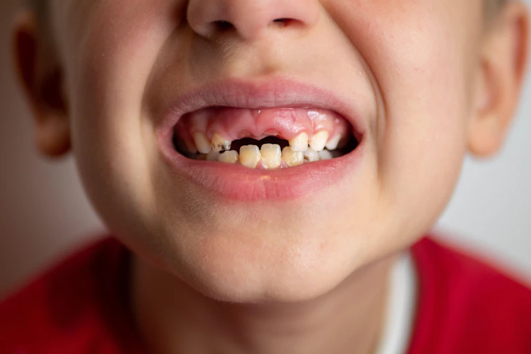A child with bad teeth