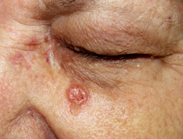 A basal cell carcinoma on an elderly person's cheek.