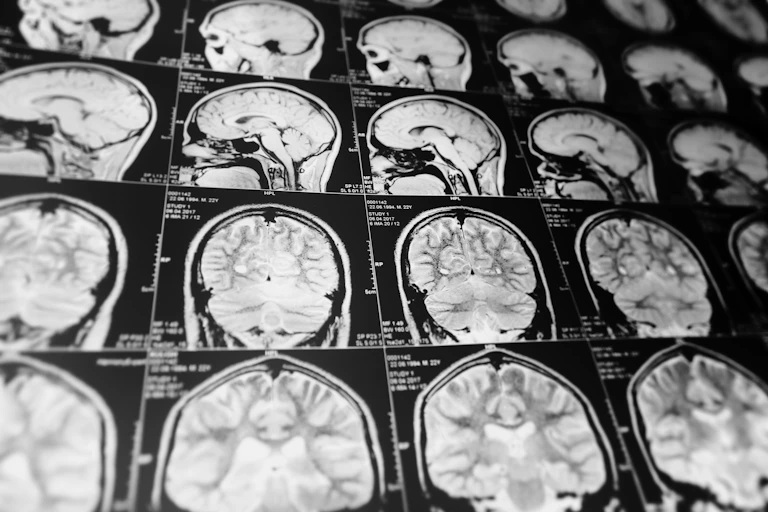 A screen displaying a series of black and white brain scans.