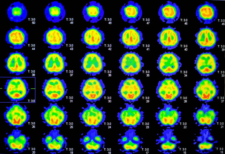 PET scan chart showing the brain.