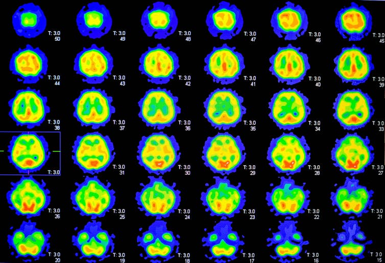 PET scan chart showing the brain.