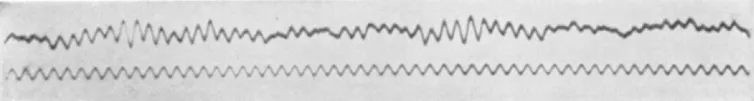 Esta é uma das primeiras leituras de EEG publicadas no estudo de Hans Berger. O traço superior é o EGG, enquanto o inferior é um traço de referência de 10 Hz.
