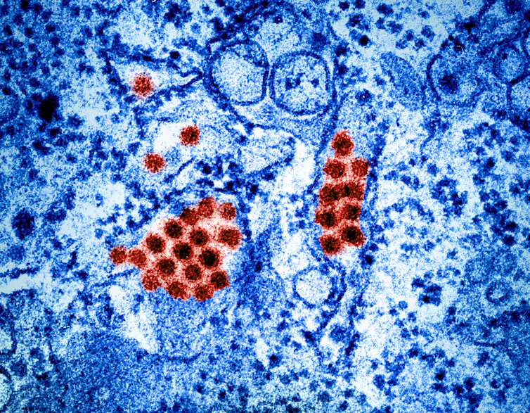 Micrographie électronique à transmission de particules du virus de la dengue (rouge, fausses couleurs).
