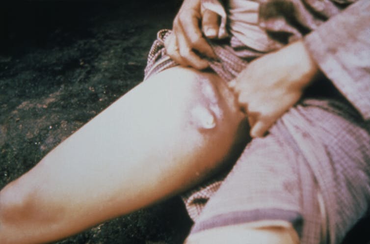 A plague patient showing his bobos.