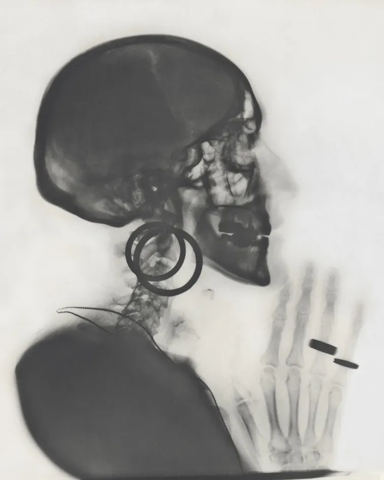 Radiografía del cráneo de M.O. MOMA