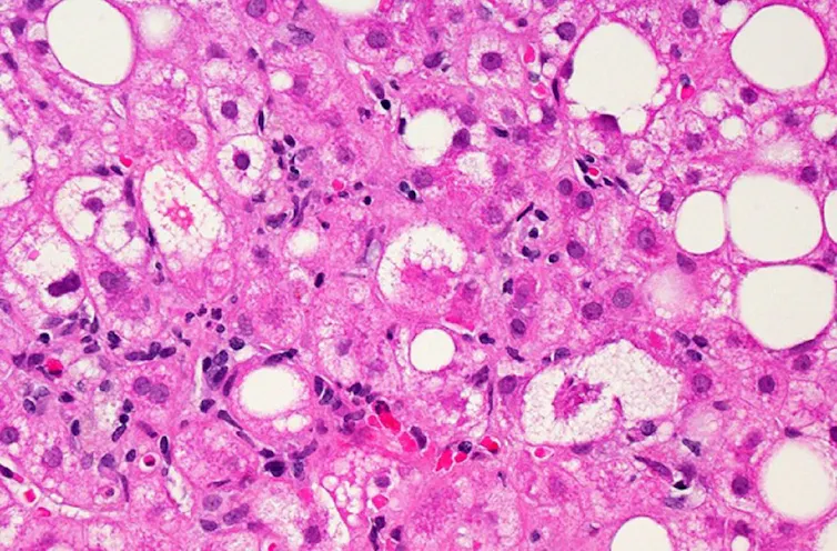 Micrograph of liver cells affected by MASLD. Some otherwise spherical pink cells are bloated with white fatty deposits.
