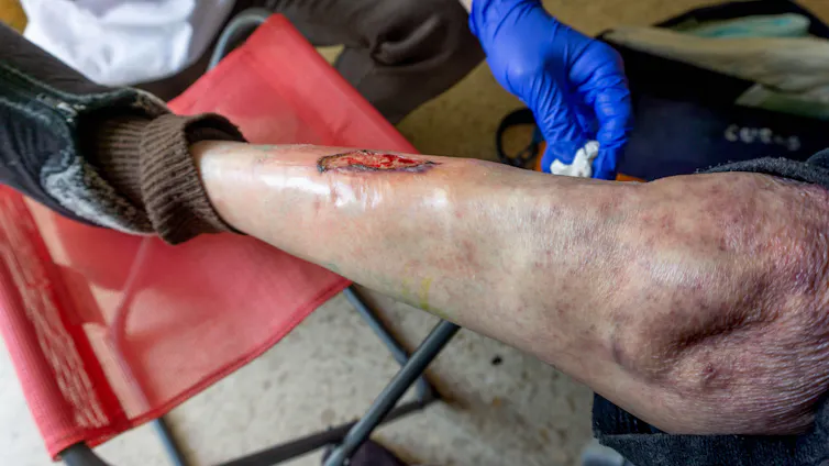 A chronic leg wound