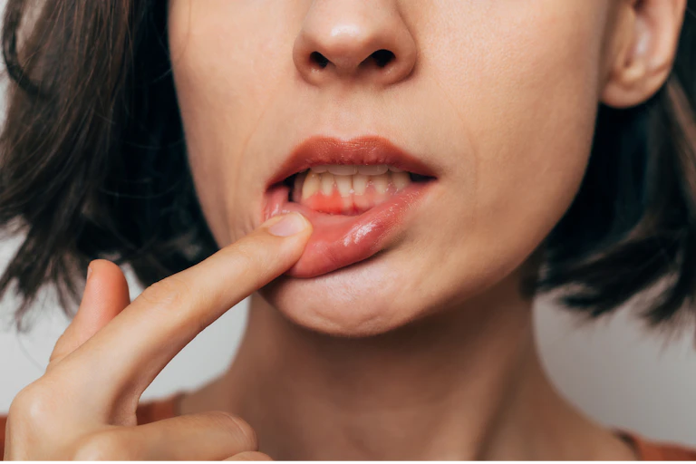 A woman with gum disease pulls her lip away from her lower teeth with a finger.
