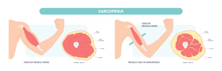Um diagrama mostra como a massa muscular pode diminuir com a sarcopenia.