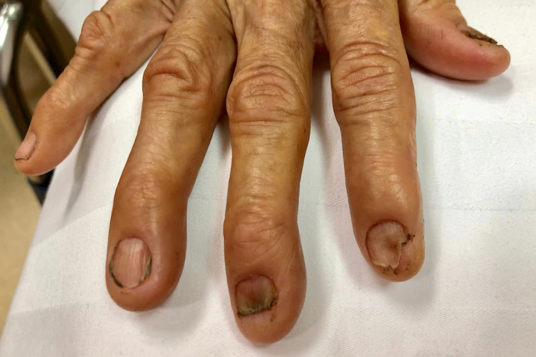 Hand with 'spoon-shaped' nails.