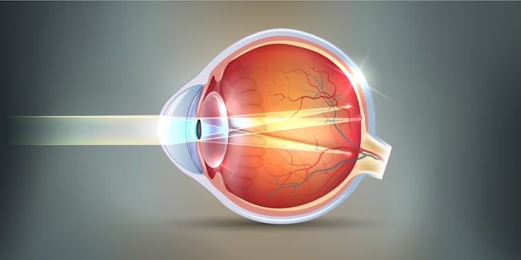 Astigmatism blurs multiple focus points and vision.