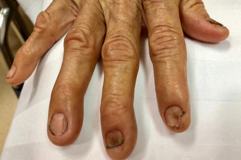Dedos de uma mão com as unhas machucadas