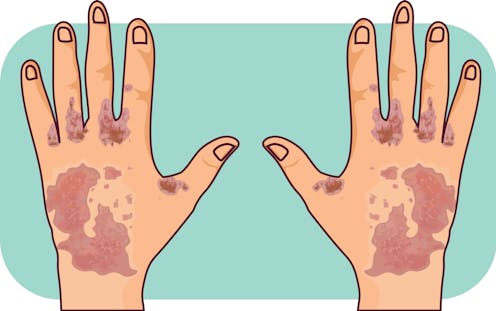 what to know about the outbreak of this contagious skin condition in hospitals