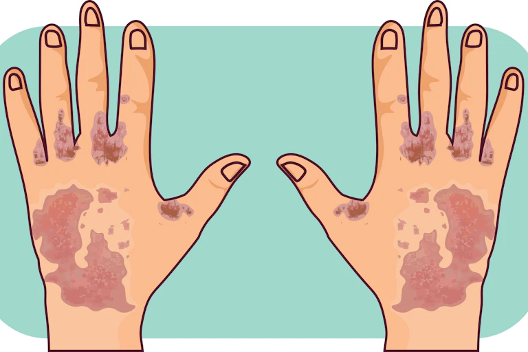An illustration of scabies on two hands.