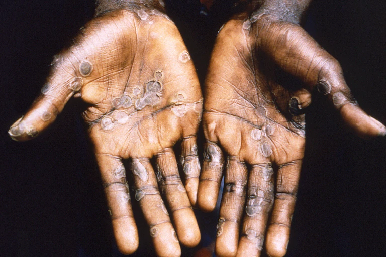 Handsd with mpox