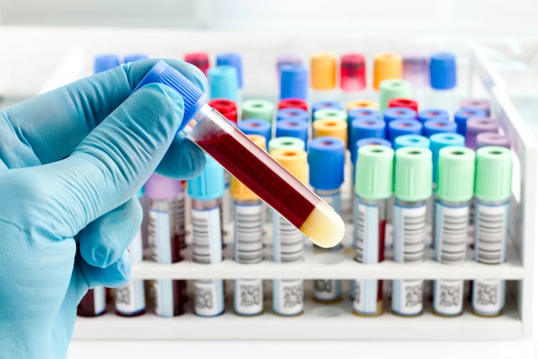 Gloved hand holding tube containing blood sample, more tubes in rack in background