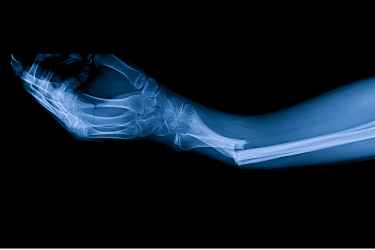 An x-ray of a fracture wrist.