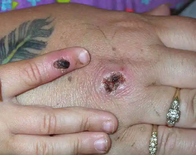 What is mpox? A microbiologist explains what’s known about this ...
