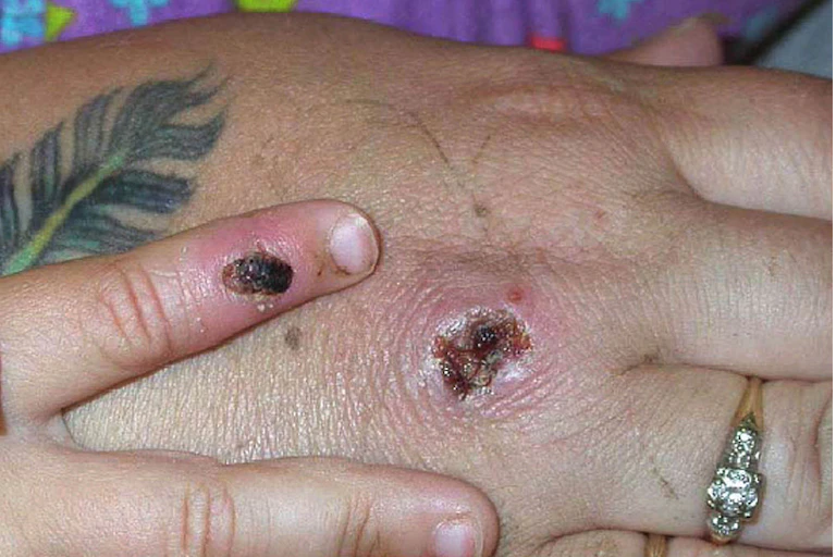 Hand with scabbed mpox lesions