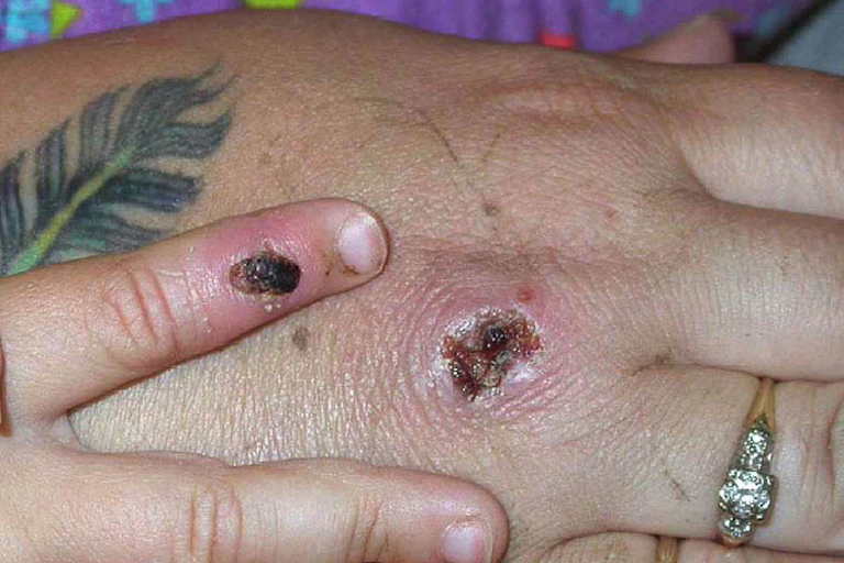 Mão com lesões de varíola em forma de crostas