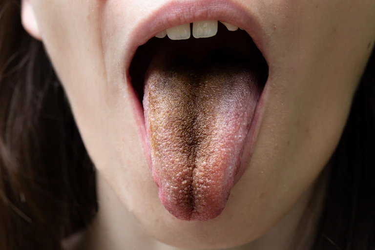 Uma pessoa jovem, com boca aberta, exibe a língua escura