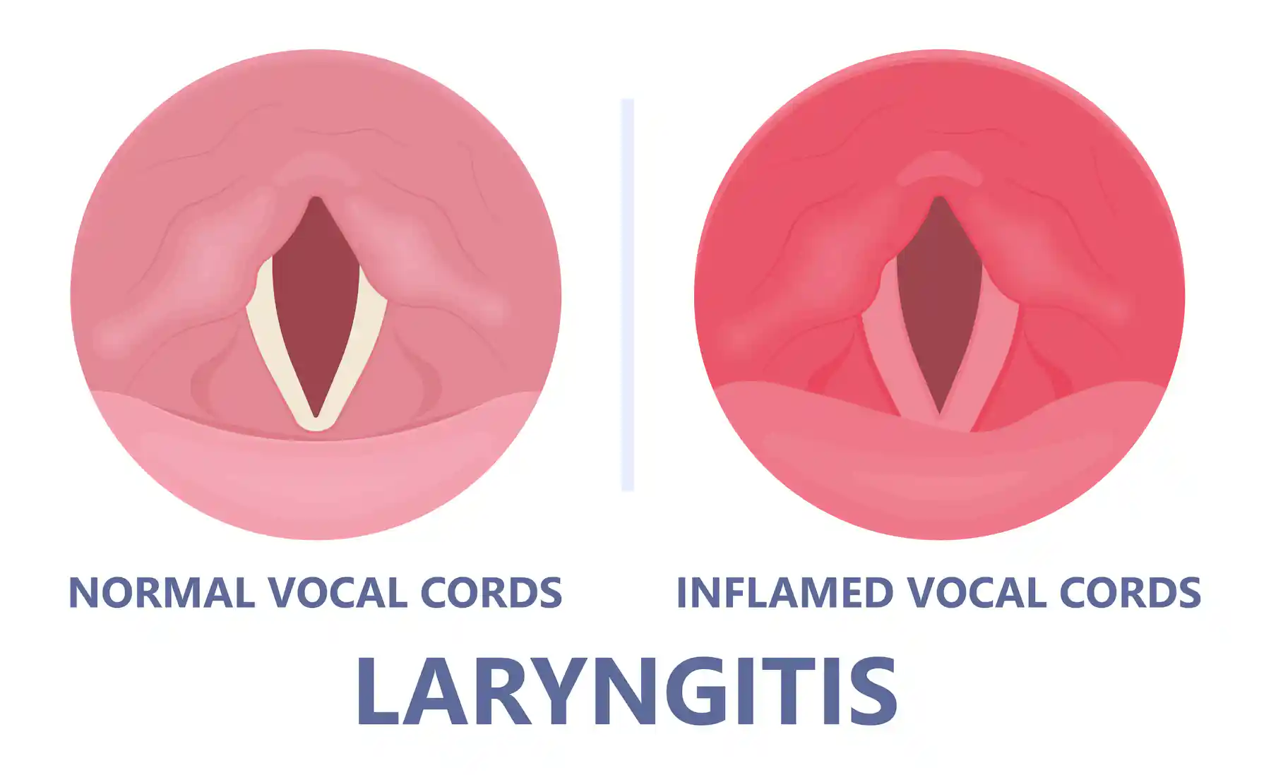 I’ve recovered from a cold but I still have a hoarse voice. What should ...