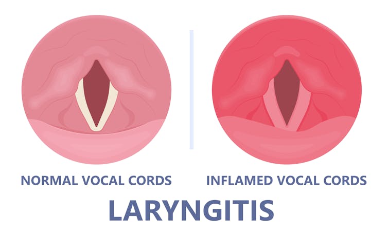 Two drawn circles comparing normal vocal cords with inflamed, red vocal cords.
