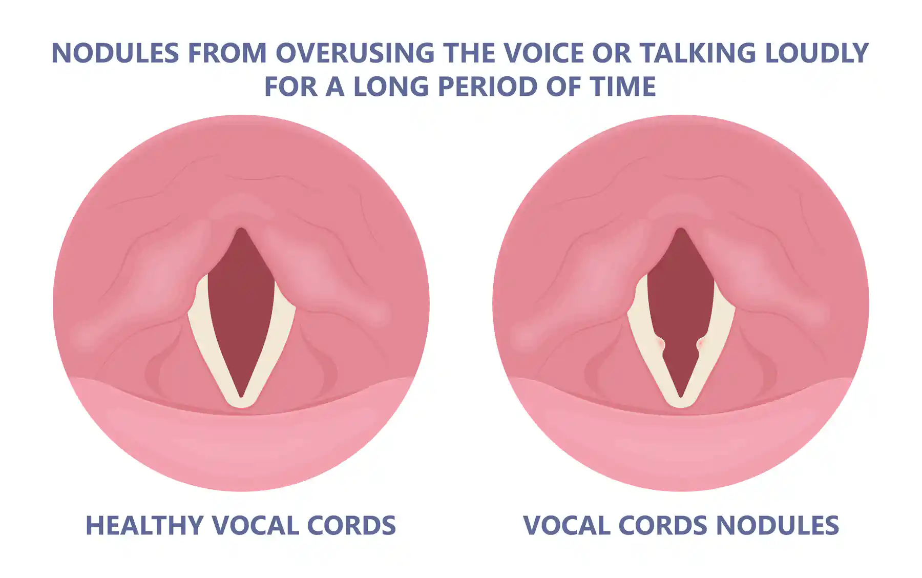 Strained Cords Examples I’ve recovered from a cold but I still have a hoarse voice. What should ...