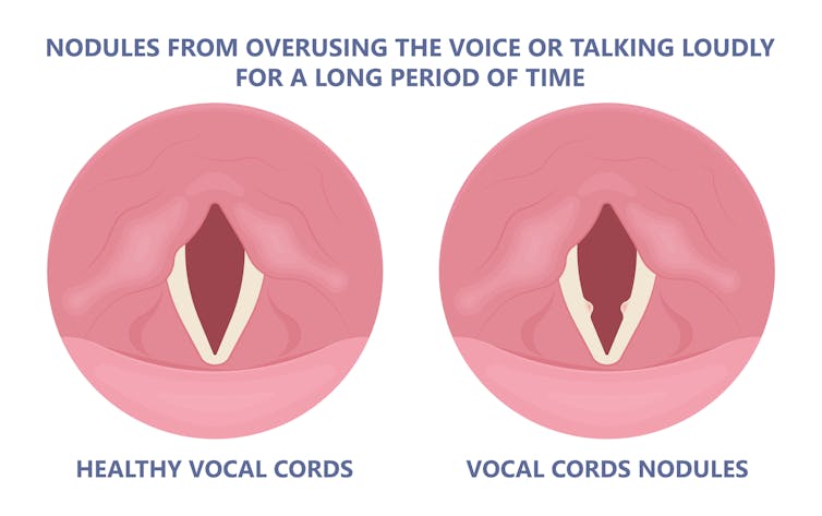 Diagram compares healthy vocal cords with cords that have nodules, two small bumps.