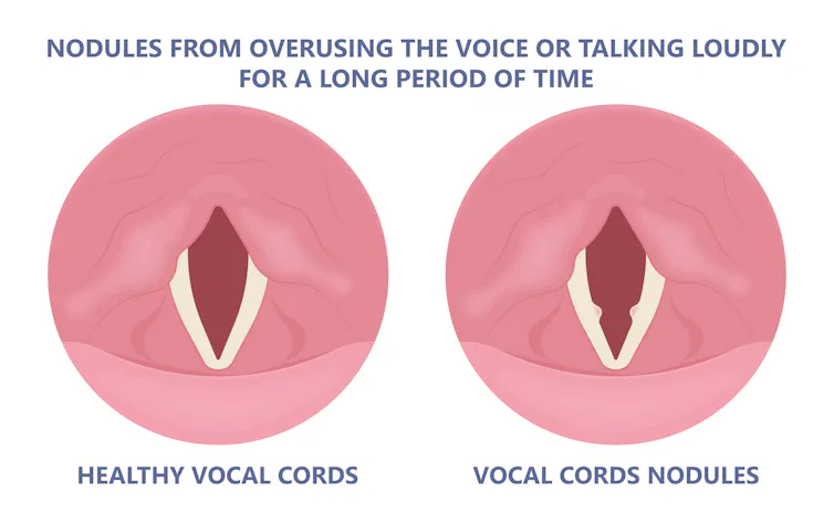 Diagram compares healthy vocal cords with cords that have nodules, two small bumps.